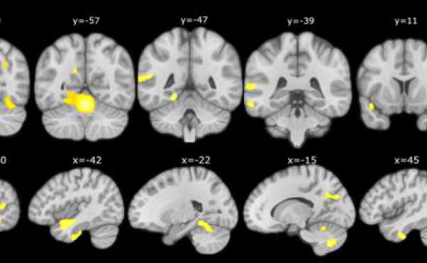 Las áreas marcadas muestran dónde se producen los cambios cerebrales en las personas con más riesgo de Alzheimer relacionado con las quejas subjetivas de memoria, respecto a las personas con menos riesgo.
