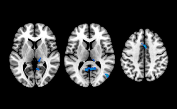 Cambios en estructura cerebral en personas con insomnio