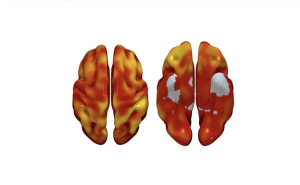 Reconstrucciones tridimensionales cerebral superior (imagen izquierda) e inferior (imagen derecha) donde se muestran aquellas regiones cerebrales con un menor metabolismo cerebral asociado con una mayor carga de placa en las carótidas. El color indica la magnitud de la asociación observada (de mayor a menor: amarillo a rojo. Gris indica zonas sin asociación).