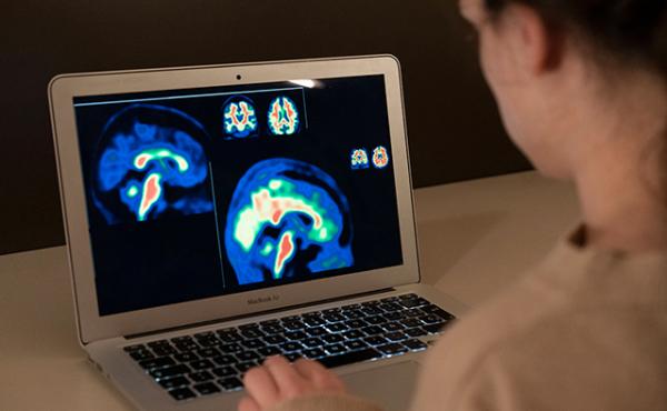 Imagen de PET cerebral de amiloide