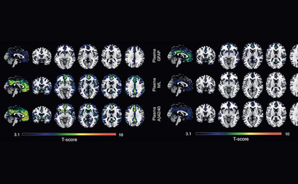 Un nuevo estudio determina dos biomarcadores en sangre que captan mejor los primeros indicios del Alzheimer