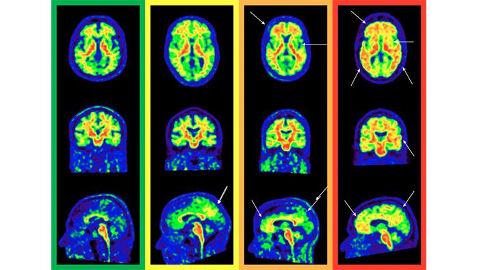 Example of cerebral PET amyloid of different pathological classification according to the visual method proposed in the study (green is without pathology, yellow, grade 1; orange, grade 2; and red, grade 3). The arrows indicate the extent of the pathology at different levels.