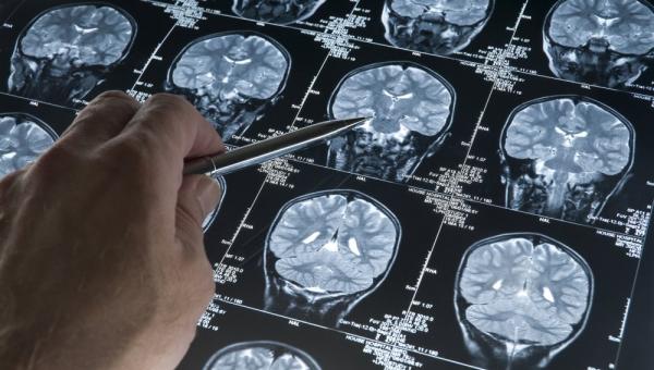 La comunitat científica adopta una nova definició per a la recerca de l'Alzheimer basada en biomarcadors