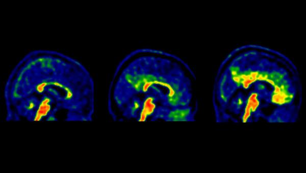 PET cerebral d'amiloide