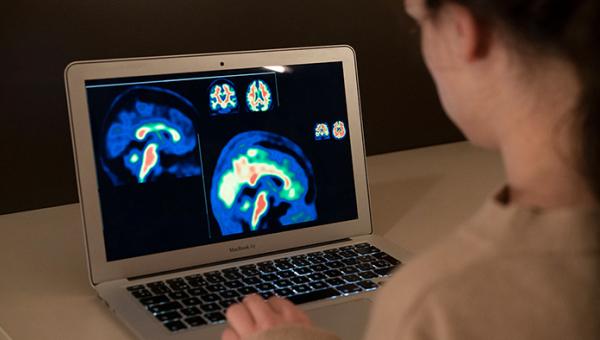 Imagen de PET cerebral de amiloide