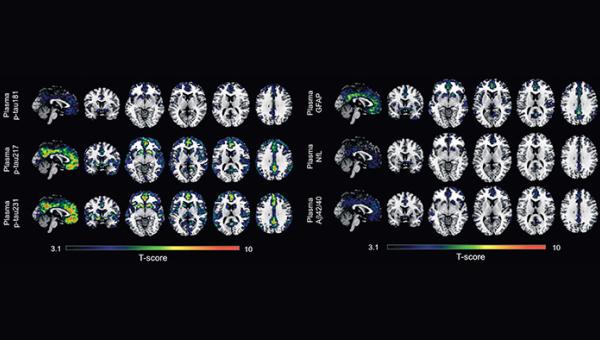 The results show that p-tau231 and p-tau217 are the best biomarkers in blood to detect the first signs of amyloid accumulation in the brain.