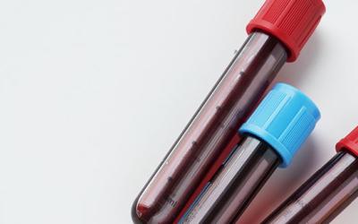 Análisis de sangre para detectar patología amiloide