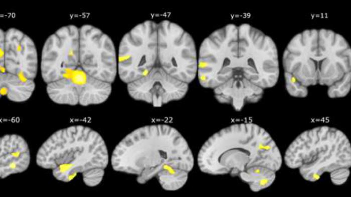 Brain changes in subjective cognitive decline