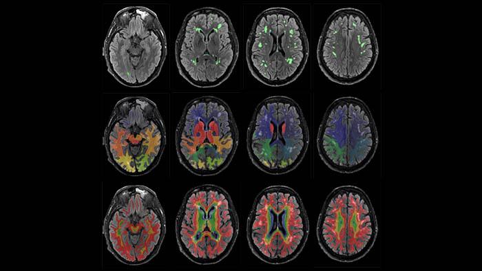 White matter hyperintensities