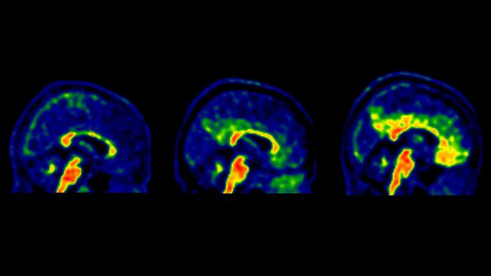 Brain Amyloid PET