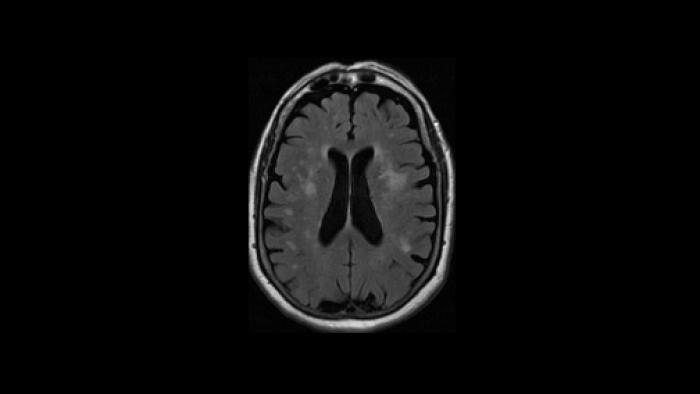 White matter hiperintensities