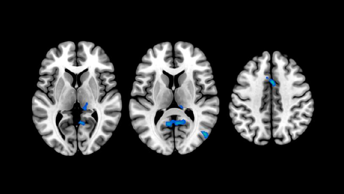 Cambios en estructura cerebral en personas con insomnio