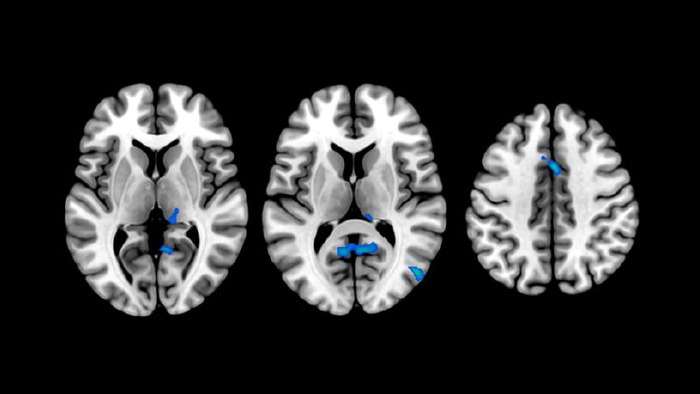 Changes in brain structure in people with insomnia