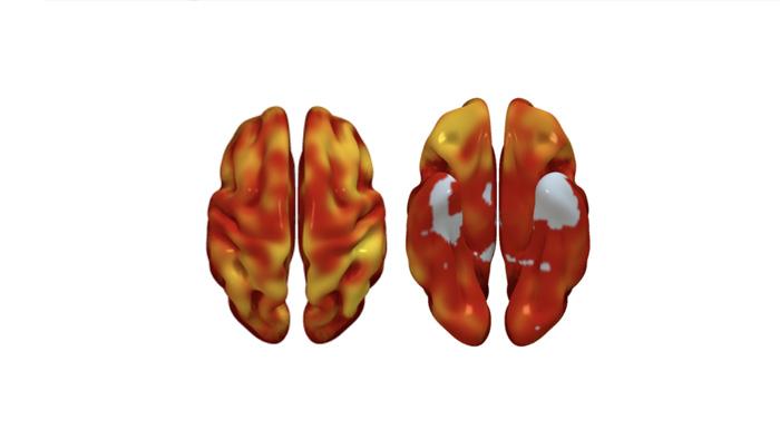3D reconstructions of superior (left) and inferior (right) brain regions, showing regions with lower metabolism associated with the presence of atherosclerotic plaques in the carotid arteries. The color code indicates the magnitude of the observation (yellow, strong association; red, lower association). Gray indicates areas showing no association with carotid plaque presence. 