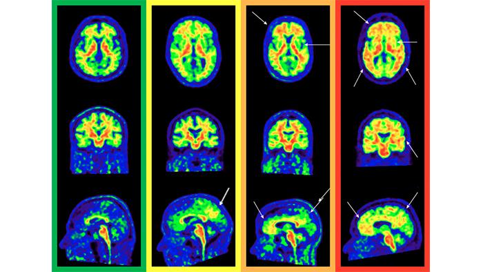 Exemple de PET cerebrals d'amiloide de diferent classificació patològica segons el mètode visual proposat a l'estudi (verd és sense patologia; groc, grau 1; taronja, grau 2; vermell, grau 3). Les fletxes indiquen l'extensió de la patologia als diferents nivells. 