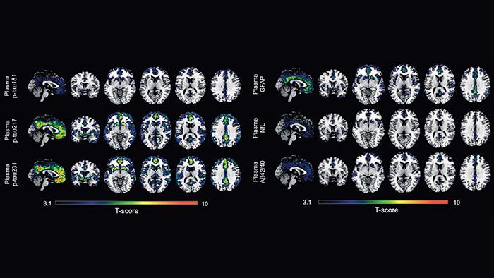 The results show that p-tau231 and p-tau217 are the best biomarkers in blood to detect the first signs of amyloid accumulation in the brain.